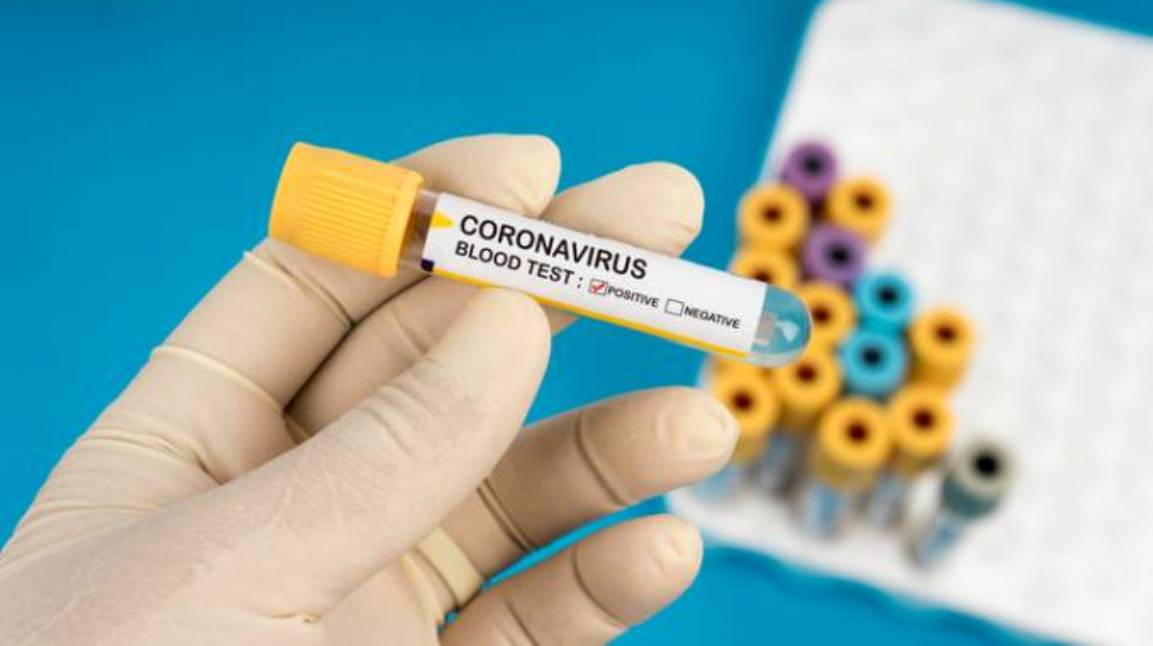 Startup vai lançar exame de coronavírus em farmácia por R$ 130 ou menos