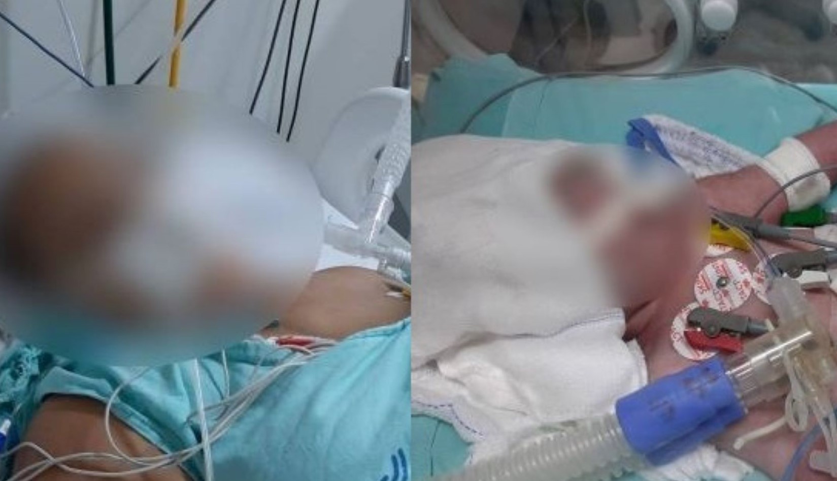 Rondonópolis | Hospital admite que criança teve couro cabeludo arrancado durante o parto