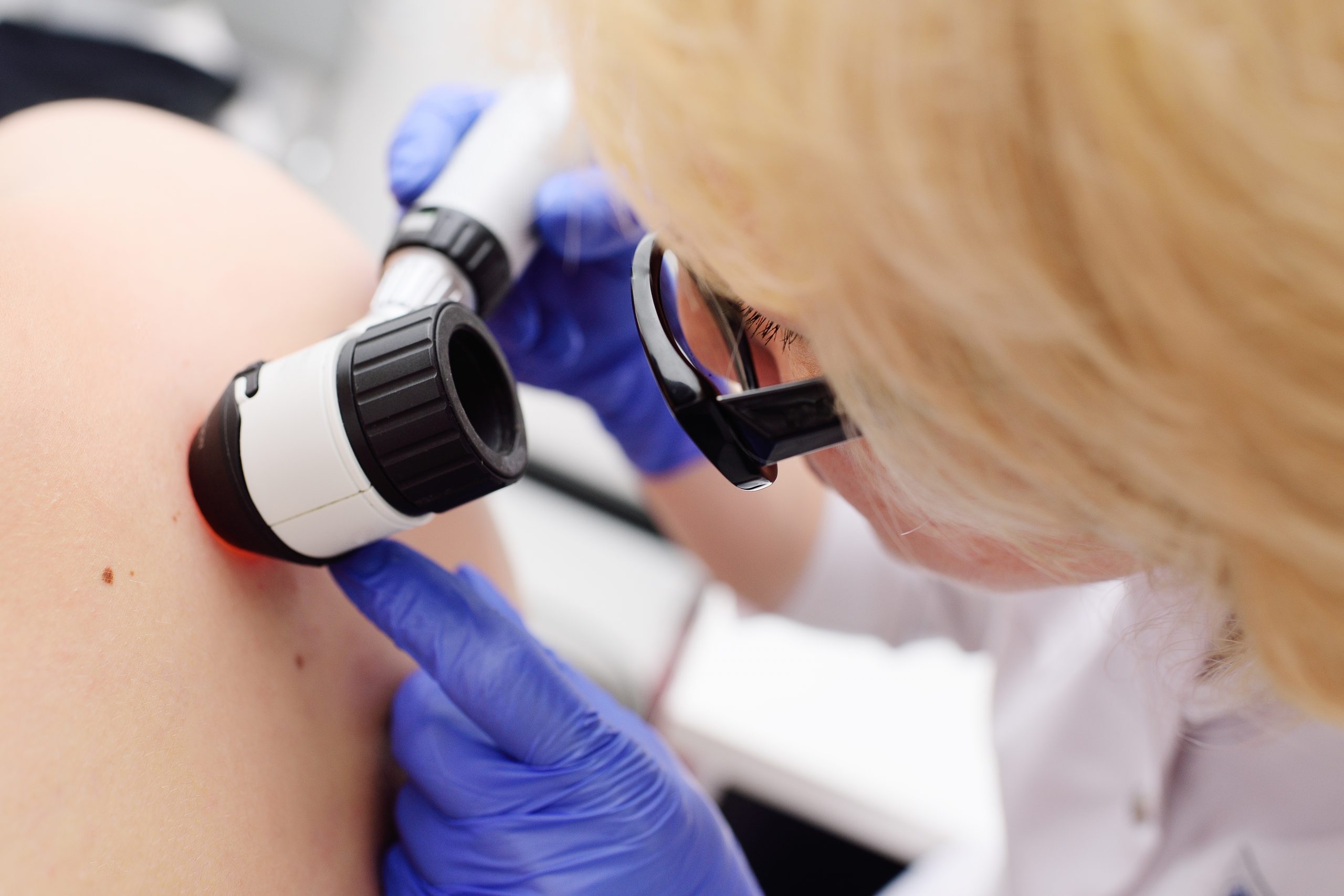 1 em cada 10 casos de melanoma ocorrem em pessoas que herdaram mutação genética