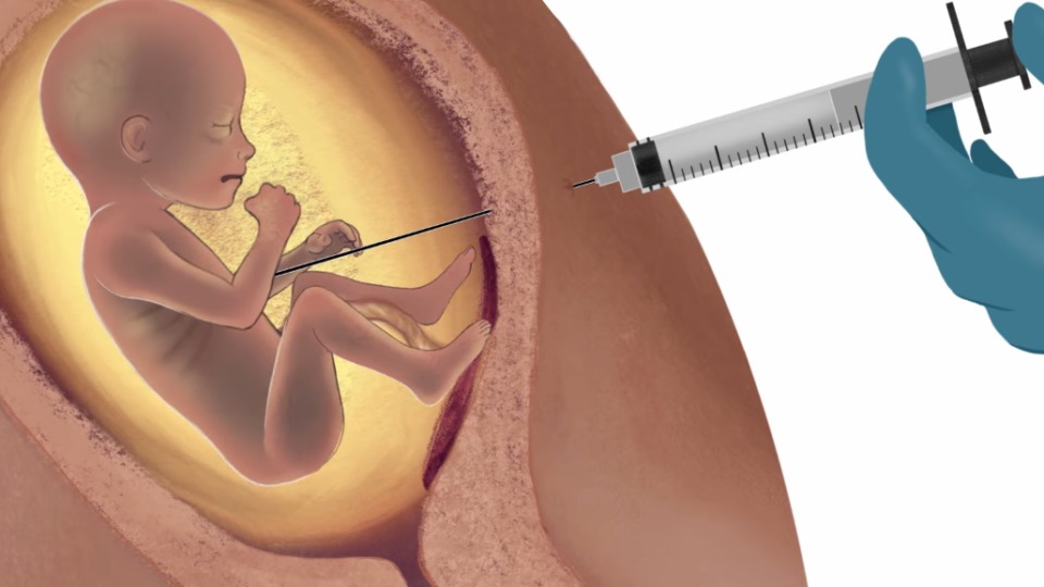 Assistolia fetal: um “direito” anti-humano